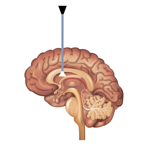 Шунтирование гидроцефалии головного мозга. Гидроцефалия эндоскопия головного мозга. Шунтирование спинномозговой жидкости.