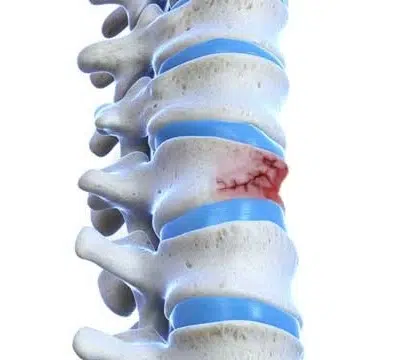 Spinal Compression Fracture: Causes, Symptoms, Diagnosis