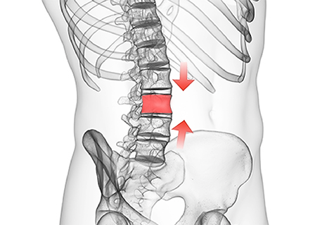 Spinal Compression Fracture: Treatment, Surgery, Recovery
