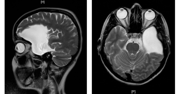 Büyük bir araknoid kisti gösteren MRI taramaları, beynin yandan görünümü ve yukarıdan aşağıya görünümü ile kistin yerini ve boyutunu vurgulamaktadır.