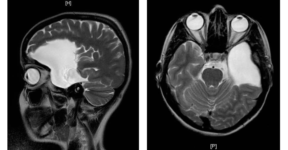 MRI scans showing a large arachnoid cyst, with a side view and top-down view of the brain, highlighting the cyst's location and size.