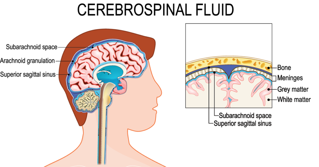 رسم توضيحي لرأس إنسان في صورة جانبية يُظهر الدماغ والحبل الشوكي والغشاء العنكبوتي حيث تتطور الأكياس العنكبوتية بشكل شائع.