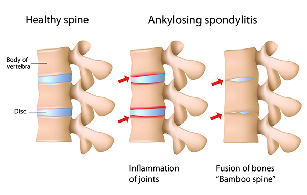 Illustration of the ankylosing spondylitis of the spine.
