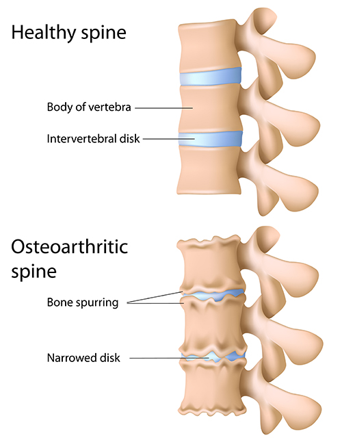 Illustration of the spinal osteoarthritis.