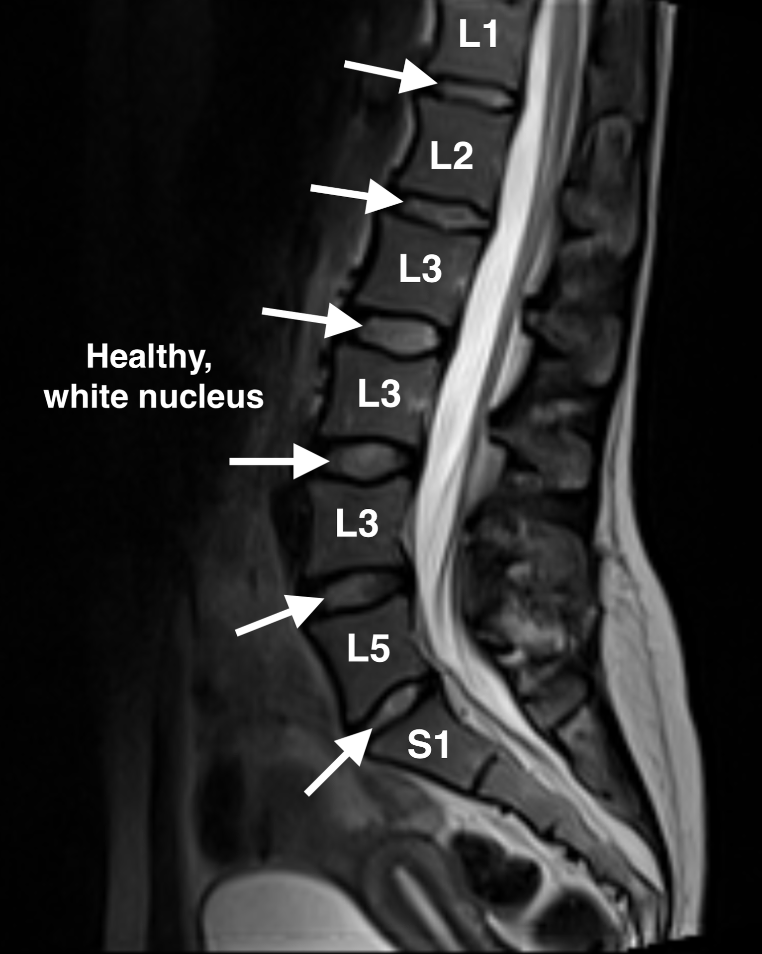Lumbar Disc Herniation: A Comprehensive Overview